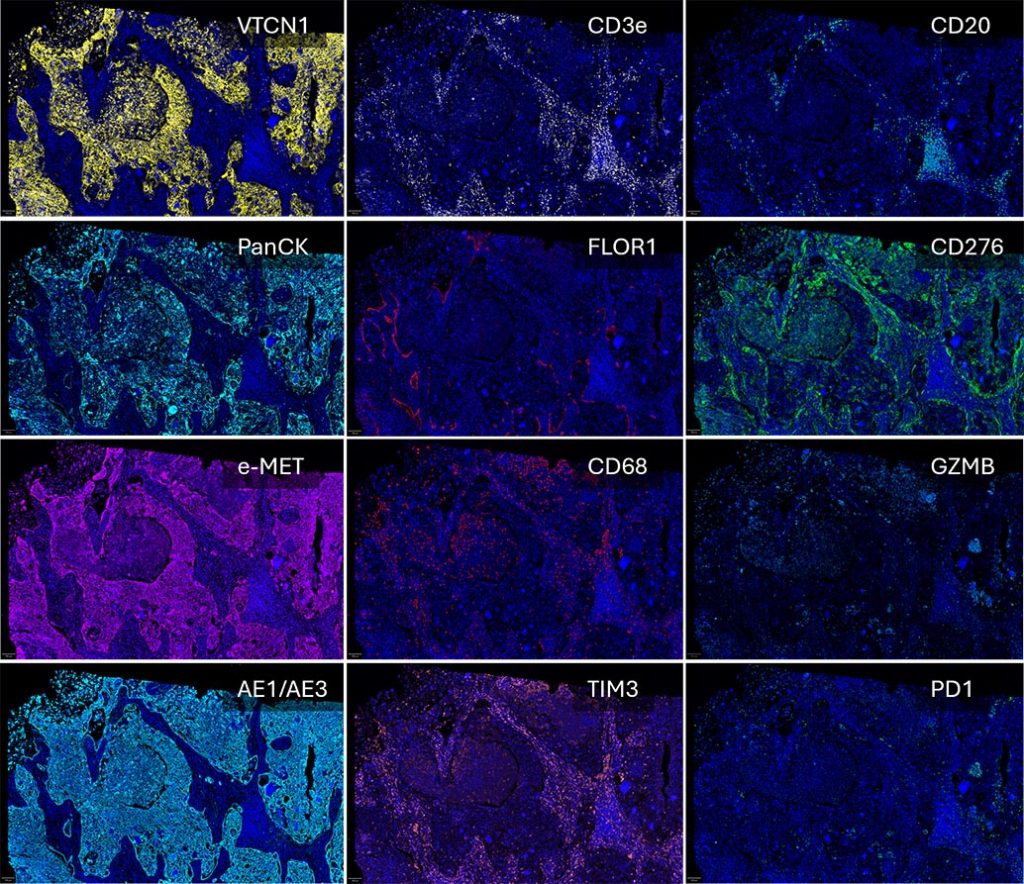 Multiplex Spatial Profiling in Lung Squamous Cell Carcinoma (LUSC)